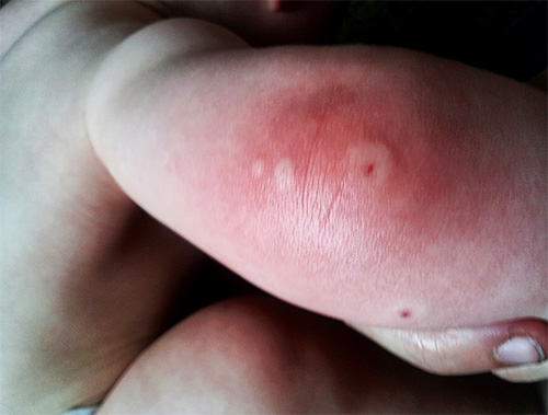 Đừng chủ quan khi vết côn trùng cắn sưng to ngứa